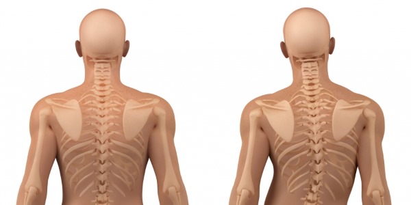 Ниже приведен список основных симптомов сколиоза у взрослых