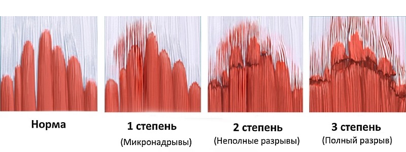 Набор симптомов будет зависеть от степени растяжения мышцы