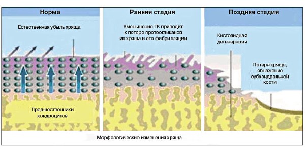Хондропротекторы назначают для восстановления хрящевой ткани