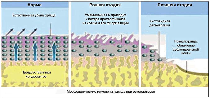 Дегенеративные процессы влияют на изменения в хрящах