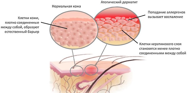 Назначают гормональный препарат при различных дерматитах