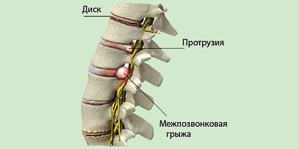 Если нерв защемило без каких-либо видимых причин, то это говорит о наличии новообразований в позвоночном столбе