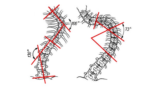 Оперативные методы применяю при 3 и 4 степени сколиоза