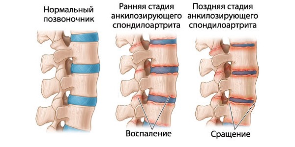Болезнь Бехтерева - сращивание позвонков в следствии воспаления
