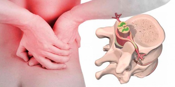 Ознакомьтесь со степенями развития люмбаго