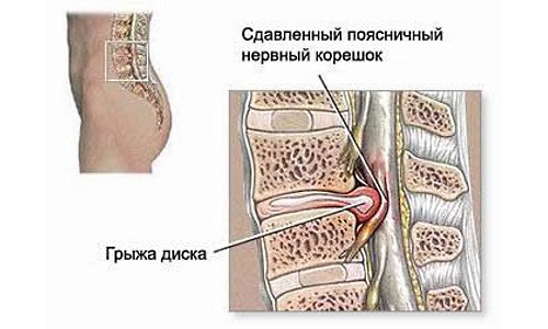 Плавать запрещено в острой фазе межпозвонковой грыжи диска