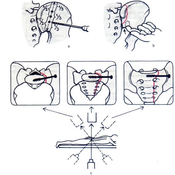 Операция необходима только при переломе крестца со смещением