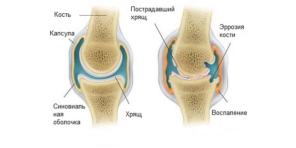 Спазгель снижает активность нейтрофилов при ревматоидном артрите