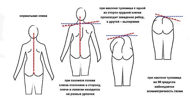 Сколиоз достаточно легко распознать визуально по асимметричным линиям на спине