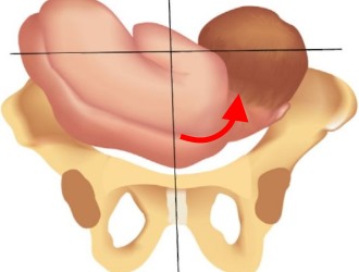 Очень часто кривошея у новорожденных развивается еще в утробе матери