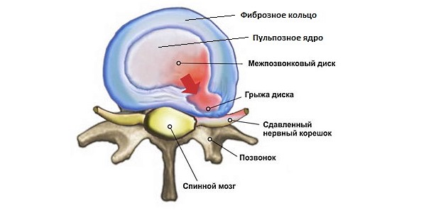 Обратите внимание на причины и симптомы позвоночной грыжи