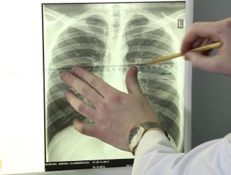 Сколиоз на 4 стадии заметен уже невооруженным взглядом