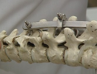 При запущенных стадиях сколиоза позвоночник выравнивают с помощью специальных эндокорректоров