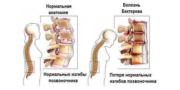 При болезни Бехтерева возникают воспаления в суставах и позвонках