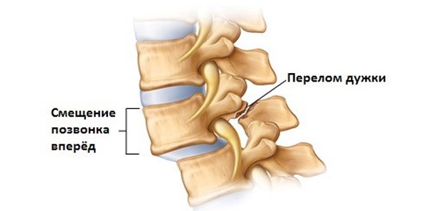 При спондилолистезе происходит выпячивания позвонка вперед