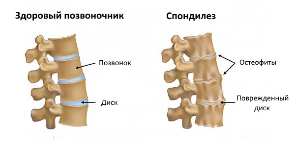 Разрастание остеофитов может быть ответной реакцией организма на воспаление и травмы в позвоночнике