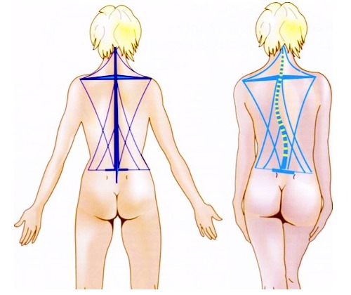 Самое первое противопоказание для осевой нагрузки это искривление позвоночника в запущенной стадии