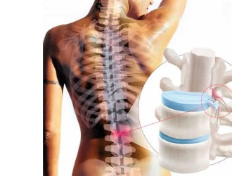 Повышенные нагрузки на поясницу могут спровоцировать развитие и обострение остеохондроза