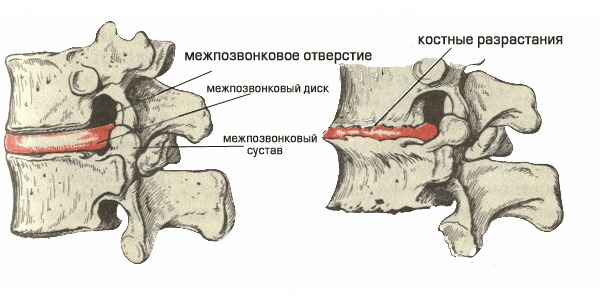 При шейном остеохондрозе 2 степени происходит дистрофия фиброзного кольца