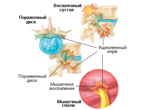 Новиган способствует устранению болей невралгического, спазмалитического и артралгического характера