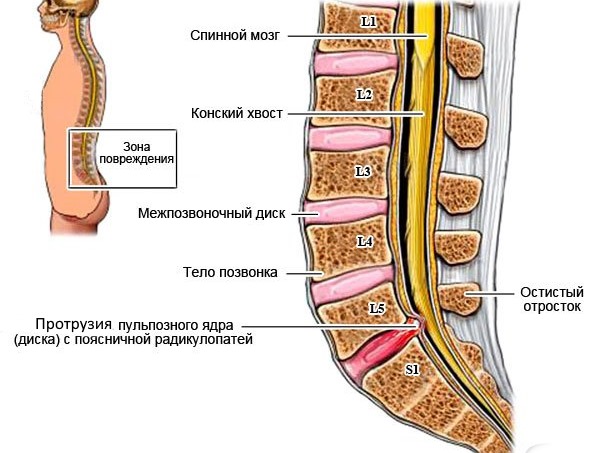 Протрузия в пояснично-крестцовом отделе может сопровождаться хрустом в спине