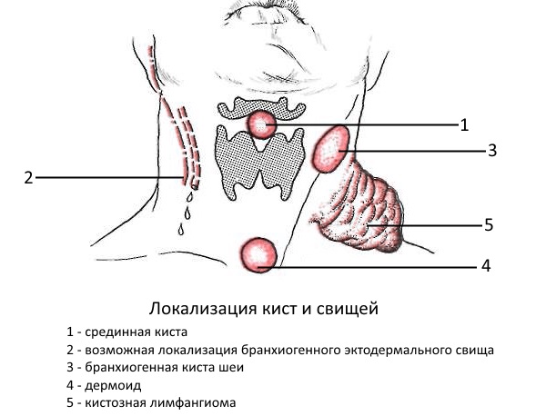Обратите внимание на виды и локализацию кист шеи