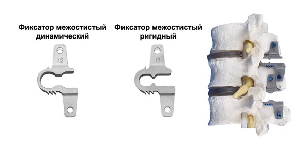 Межостистая фиксация позволяет распределить нагрузку на позвонки