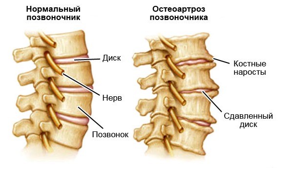 При остеоартрозе позвоночника разрушения происходят в хрящевой и костной ткани