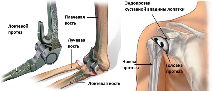 Сейчас хирурги-ортопеды учатся проводить замены мелких суставов плеча, локтей и пальцев