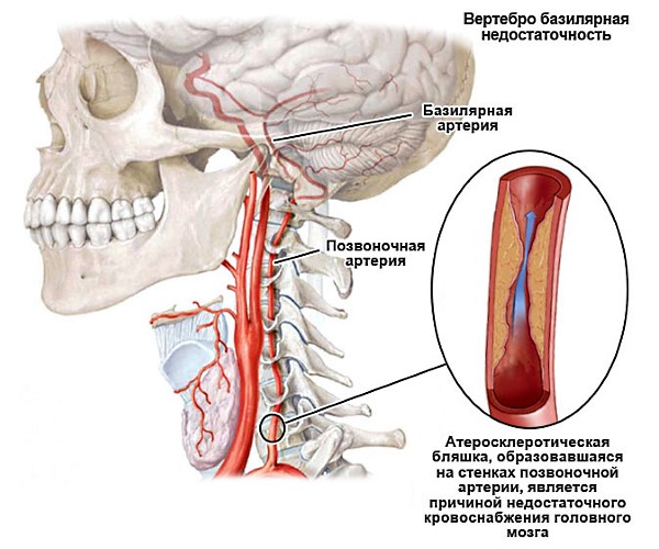 Развитию недостаточности в сосудах головного мозга способствуют заболевания позвоночника и атеросклероз