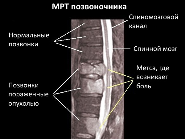 Так выглядит рак позвоночника на МРТ