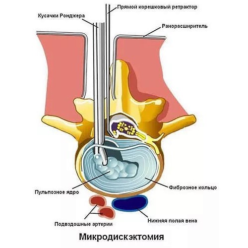 Микродискэктомия подразумевает удаление межпозвоночного диска