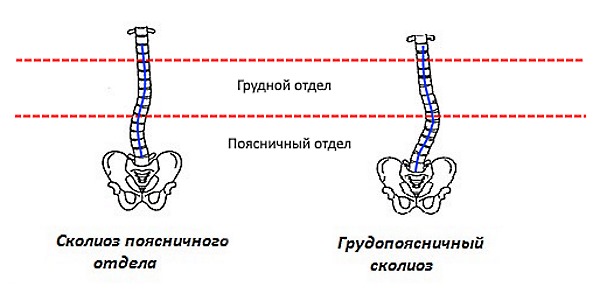 Сколиоз поясничного отдела может развиваться параллельно с искривлением позвоночника в грудном отделе