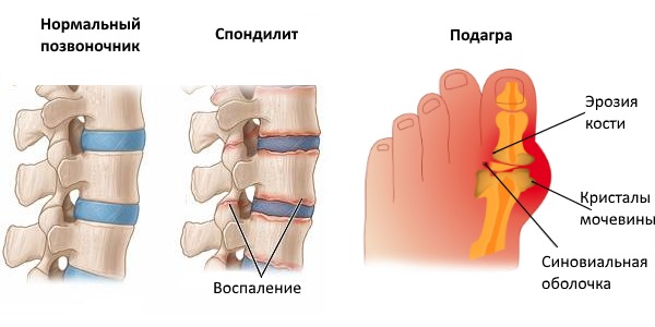 Преимущественно препарат Диклоберл назначают при спондилите и подагре