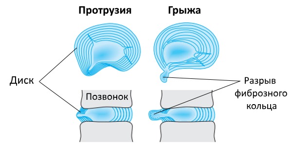 Обратите внимание на то, чем отличается грыжа от протрузии