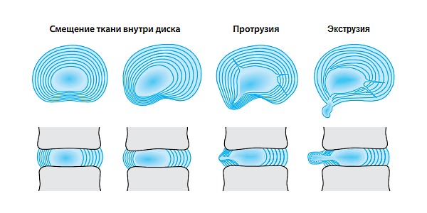 Вот так выглядит межпозвонковый диск в момент развития грыжи
