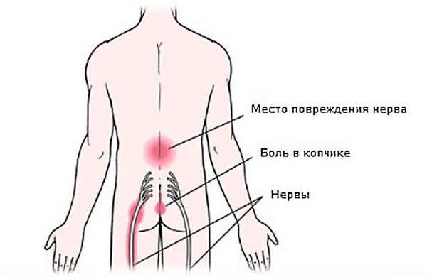 Чаще всего при радикулите пациент испытывает боль в области поясницы