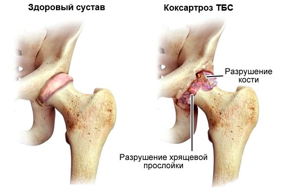 Преимущественно назначают Мовалис при суставных болезнях