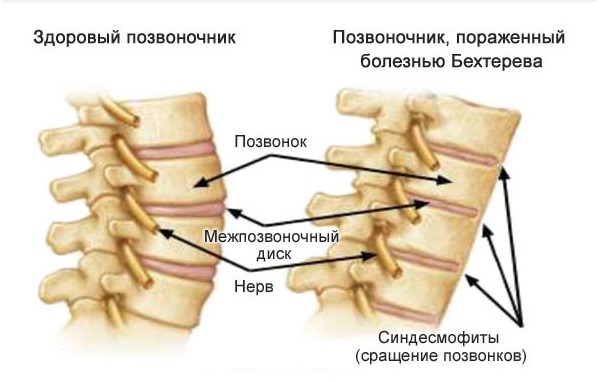 У женщин при спондилоартрите позвонки сращиваются между собой, хотя чаще всего болезнь протекает в менее агрессивной форме, чем у мужчин