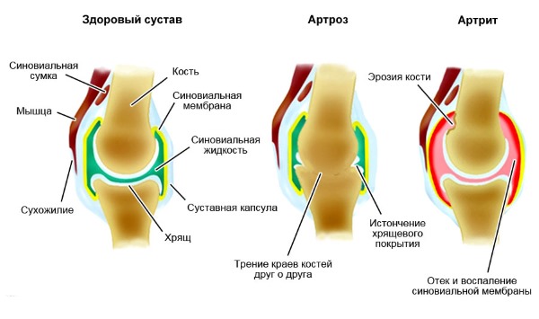 Использовать Артромед Ультра можно также тем, кто находится в зоне риска заболеть суставными патологиями