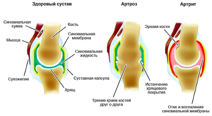 Крем помогает справиться с различными типами воспалений и дегенеративных изменений в суставах