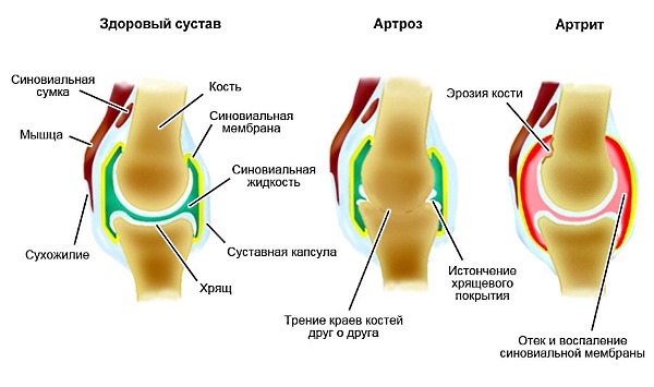 Настойка Сабельника помогает справиться с симптомами артрита и артроза