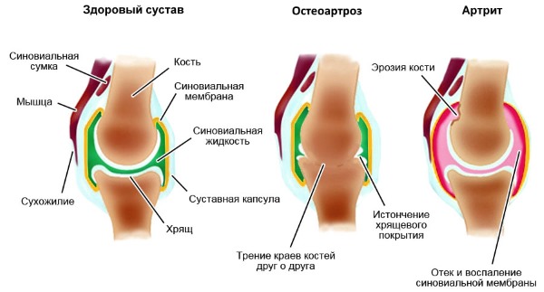 Используют Ревмоксикам при заболеваниях суставов и позвоночника