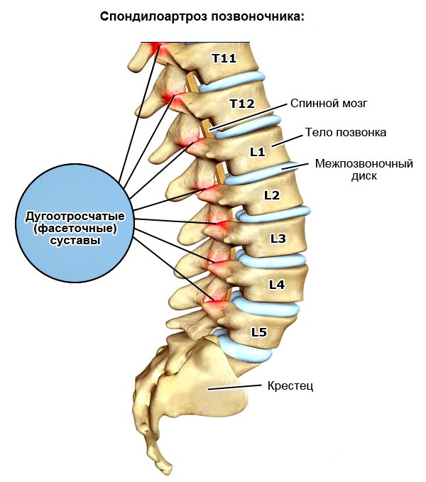 Спондилоартроз характеризуется воспалением суставов позвоночника, является причиной постоянных болей в спине