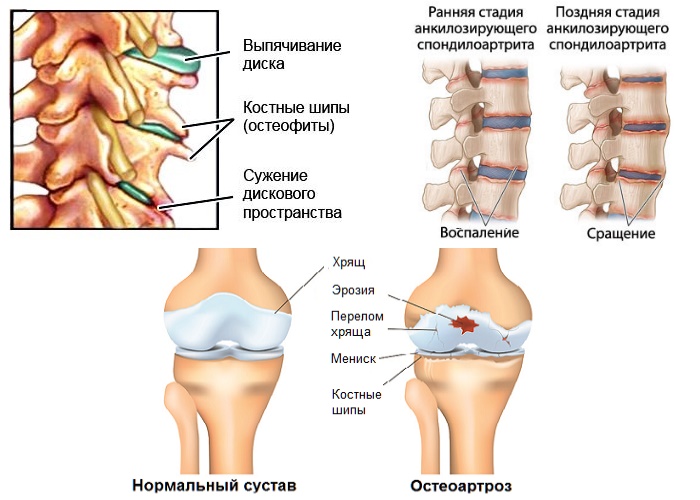 Заболевания суставов с воспалением служат показанием для применения Мелофлекса