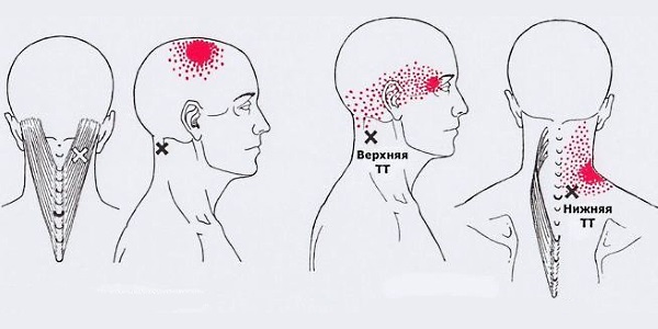 Из-за появления остеофитов возникает мышечное напряжение и боли в шейном отделе