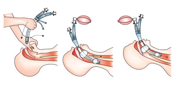 Назначают Нимбекс в основном при интубации трахеи