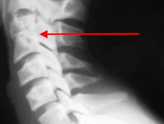 Для диагностики аномалии используют КТ, МРТ и рентген