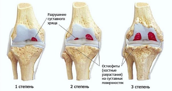 Используют Нимид при патологиях суставов