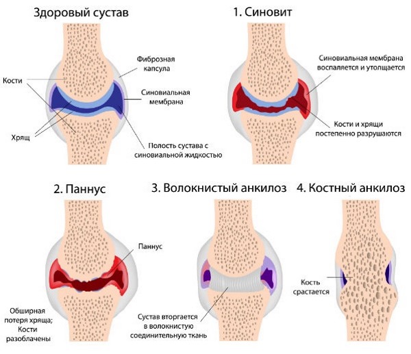 Ибуклин позволяет лечить различные типы болей: артралгия, невралгия, миалгия